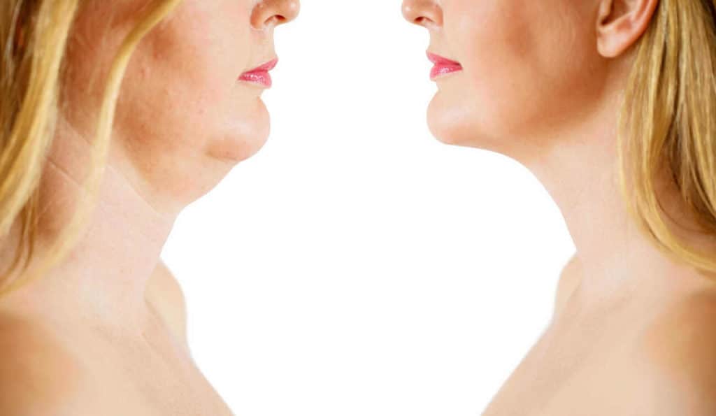 Double Chin treatment Bournemouth before and after results