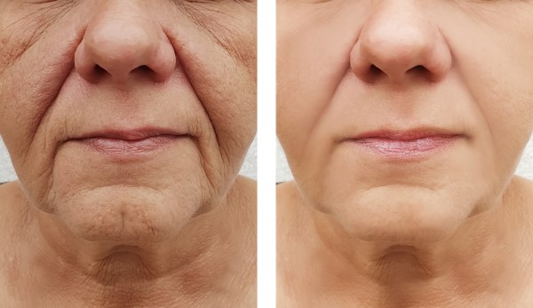 Learn more about Morpheus8 Treatment Bournemouth today!
