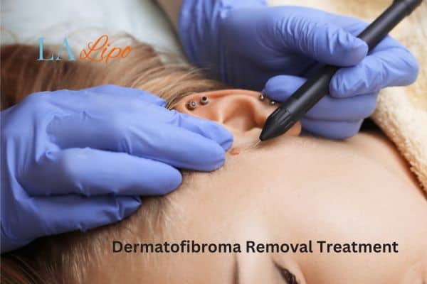 Dermatofibroma Removal Treatment Bournemouth