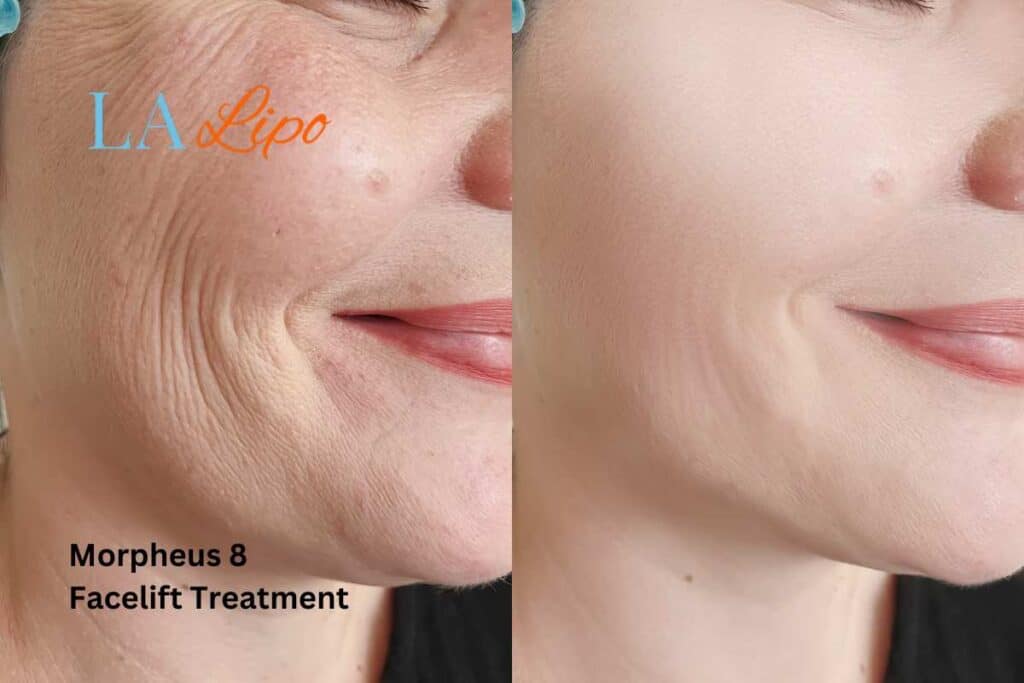 Morpheus8 Treatment Bournemouth for flawless skin! Call us today!