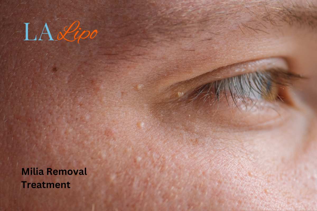 Cryopen Milia Removal: Is It the Easiest and Safest Option Bournemouth?