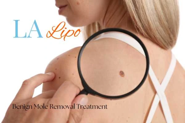 Why getting moles removed Bournemouth can boost your confidence!
