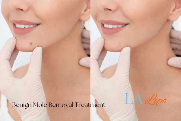 Woman's before and after results of being moles removal treatment Bournemouth