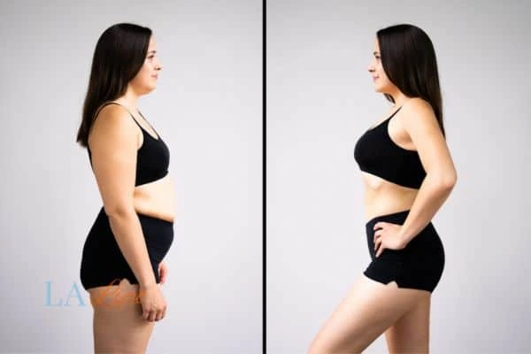 image of woman before and after results of LA-EMS Body Sculpting Bournemouth to help treat Diastasis recti