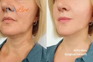 hi-fu for wrinkles Bournemouth before and after results