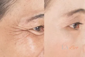 Before and after results of woman - HI-fu wrinkles reduction treatment Bournemouth