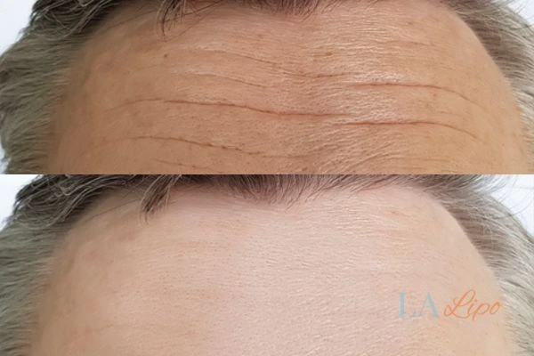 results of HIFU Bournemouth on mans forehead to help reduce lines and wrinkles