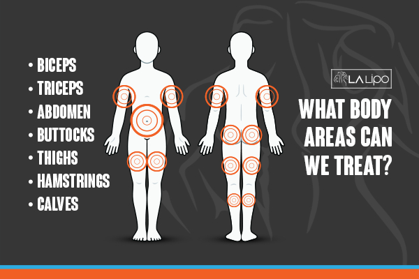 Graphic to show areas you can have LA-EMS Body Sculpting Bournemouth treatment.