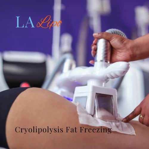 fat freezing - Cryolipolysis Bournemouth