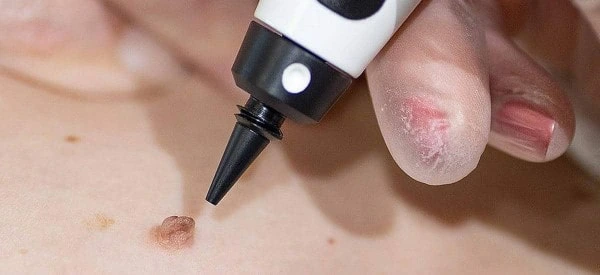 skin tag removal using cryopen Bournemouth
