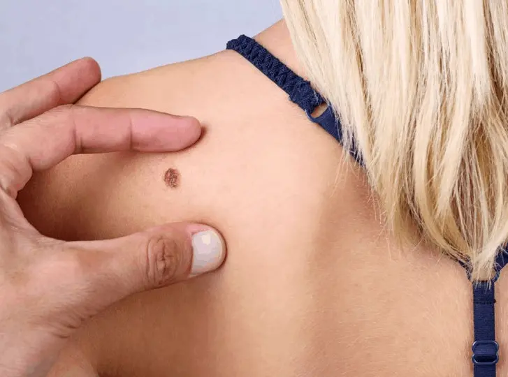 woman having mole removal Bournemouth consultation before treatment.