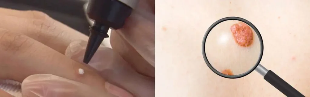 Cryopen for mole removal Bournemouth - speak to our team today!