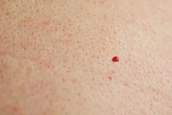 close up of a cherry angioma Bournemouth