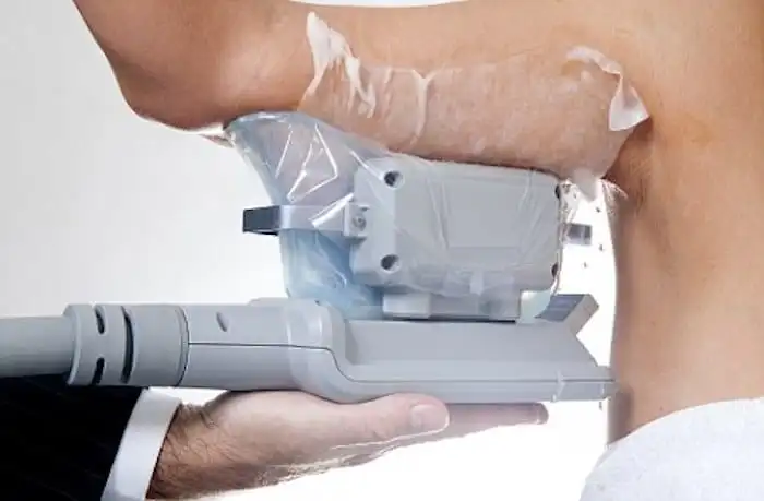 Picture of fat freezing Bournemouth on the upper arms.