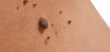 image of a skin tag Bournemouth