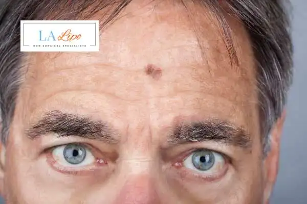 Solar Lentigo Removal Bournemouth image of man with mark on his forehead