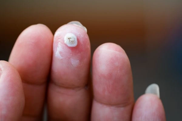 wart on person finger - cryotherapy to treat from LA LIPO Bournemouth