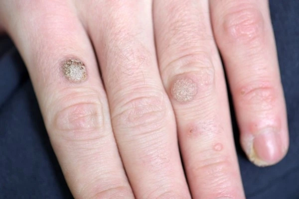 photo of warts on person hand - see wart removal Bournemouth from LA LIPO