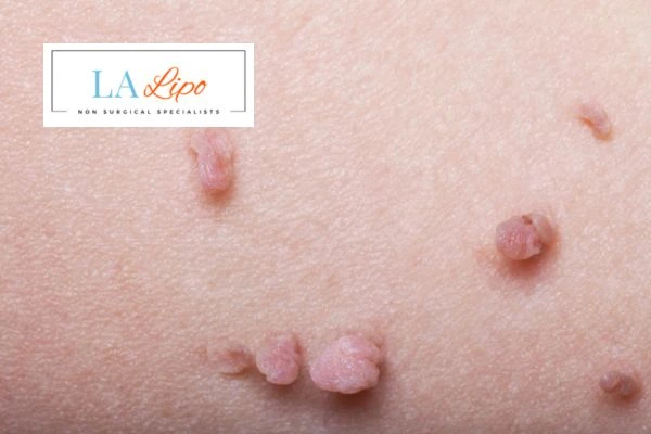 Does cryopen skin tag removal Bournemouth hurt? Find out now call our team today!