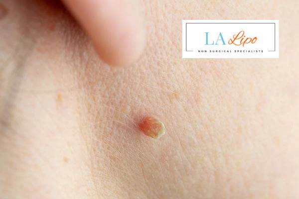 Book skin tag removal Bournemouth today speak to our team now!