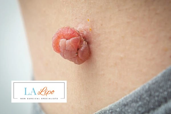 Interested in skin tag removal Bournemouth? Concerned about the pain? Find out more today!
