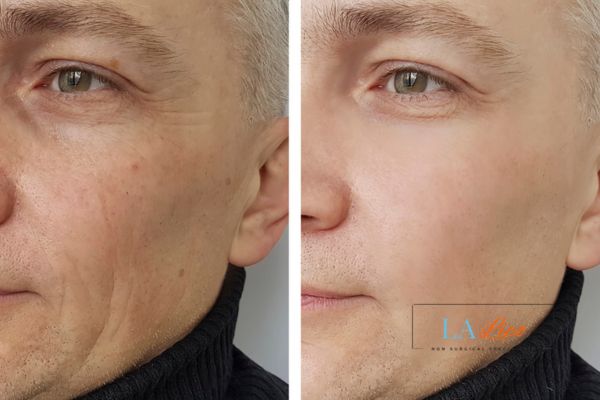 See the amazing results of Morpheus8 Treatment Bournemouth!