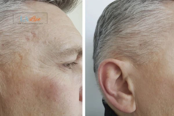 Mens Before & After Morpheus 8 Results Bournemouth