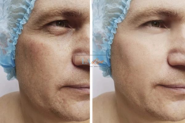 Before and after Morpheus 8 Results Bournemouth