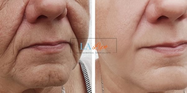 Older lady deeper wrinkle reduction - LA LIPO Morpheus 8 Results Bournemouth