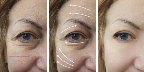 Amazing eye lift Morpheus 8 results Bournemouth