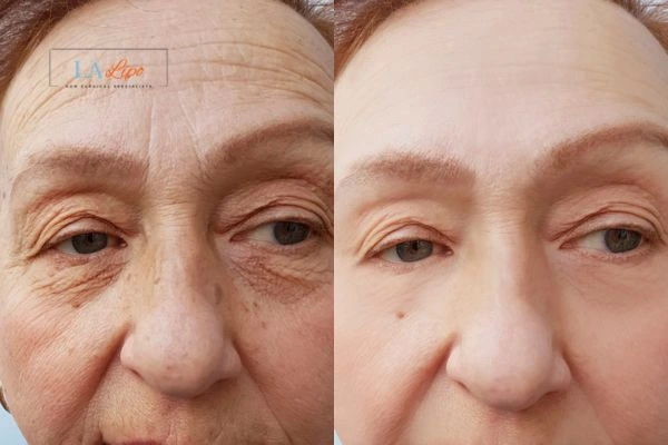 The powerful benefits of Morpheus8 Treatment Bournemouth - Call Our team today!