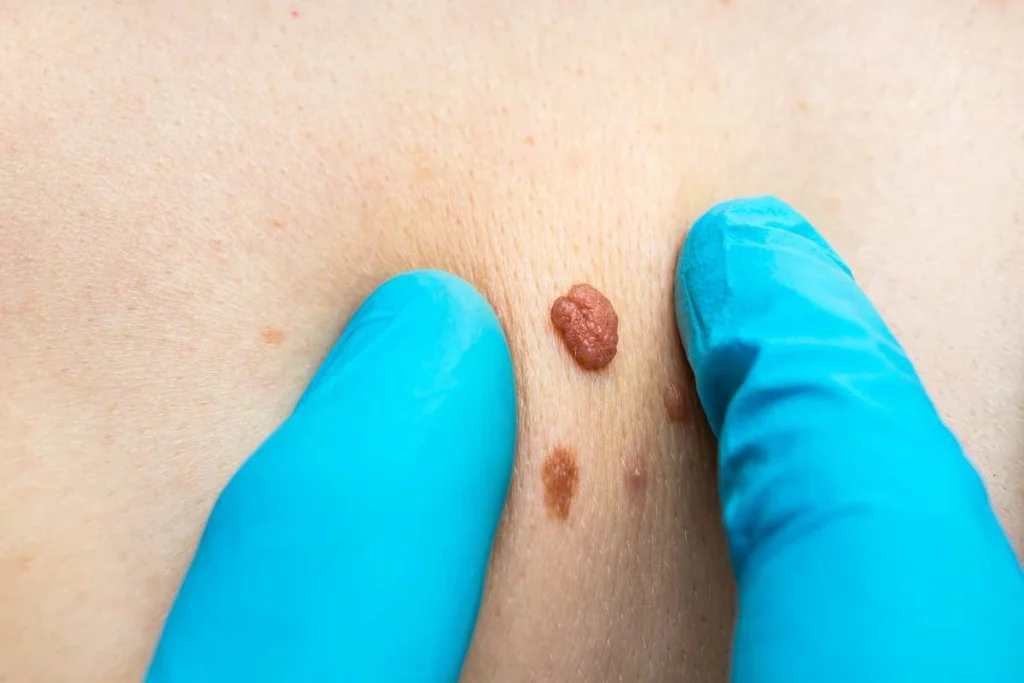 LA LIPO Cryopen Lesion Removal Prices Bournemouth