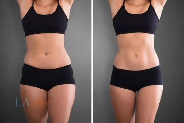 before and after results of non-surgical treatment to help a woman's body image and mental health Bournemouth