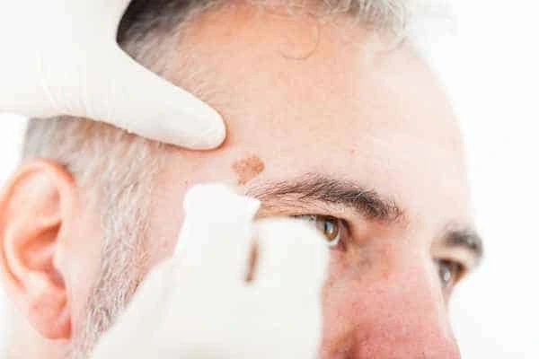 Age spots and elderly people Bournemouth what is the link?