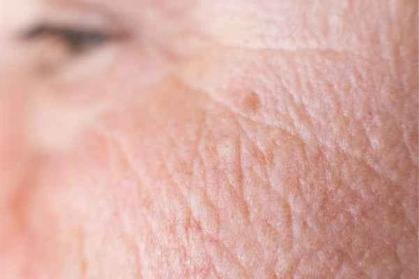 close up picture of a woman's face showing an age spot Bournemouth