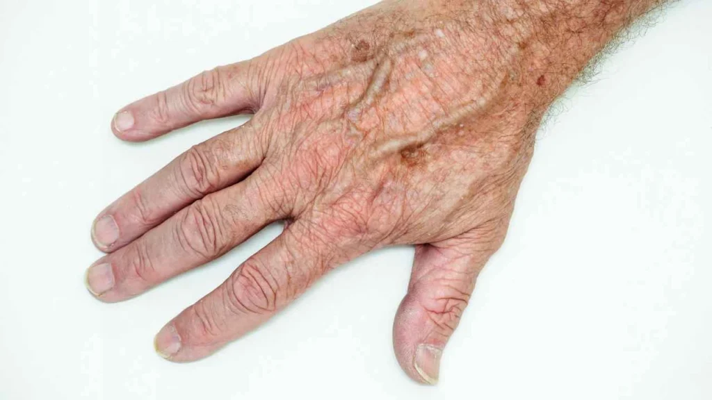 Male hand showing age spot Bournemouth