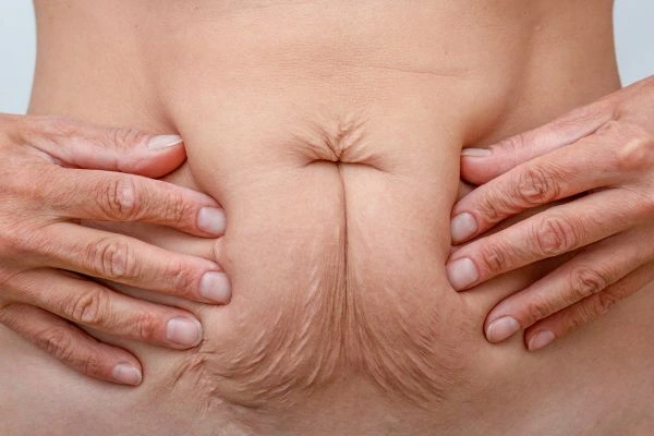 Image of a woman's stomach with loose skin - example of skin tightening Bournemouth options