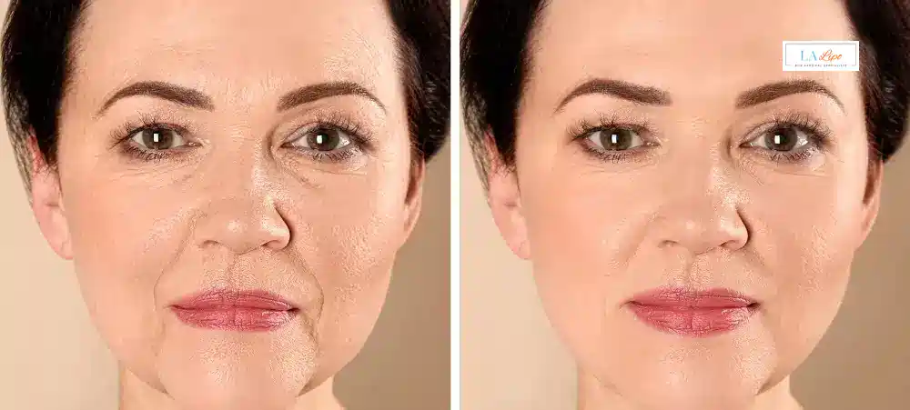 How Long Does It Take to See Results and How Long Do They Last Bournemouth?
