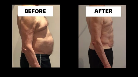 What Symptoms Can Diastasis Recti Cause in Men? Weak Core, Back Pain and Poor Posture Bournemouth